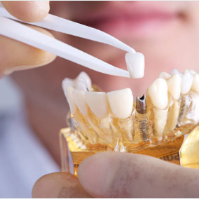 5 Things You Should Know About Dental Implants 5 Things You Should Know About Dental Implants