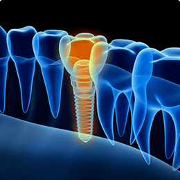Dental Implants