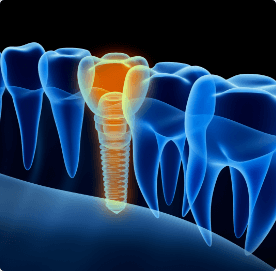 Dental Implants