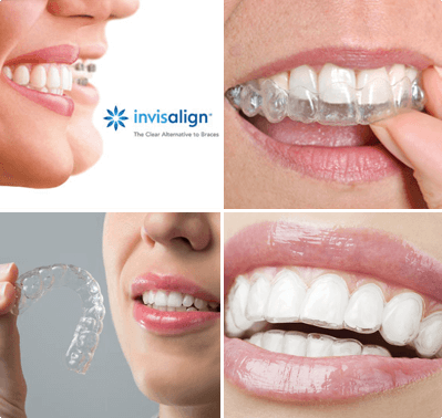 Invisalign Treatment Downtown Montreal - Alpha Seaforth Clinique Dentaire