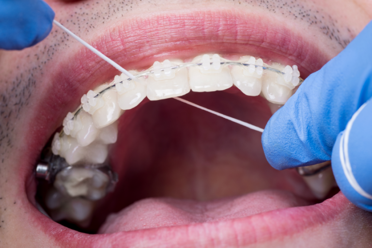 Top 3 Essential Tips and Tricks to Make Flossing with Braces Easier