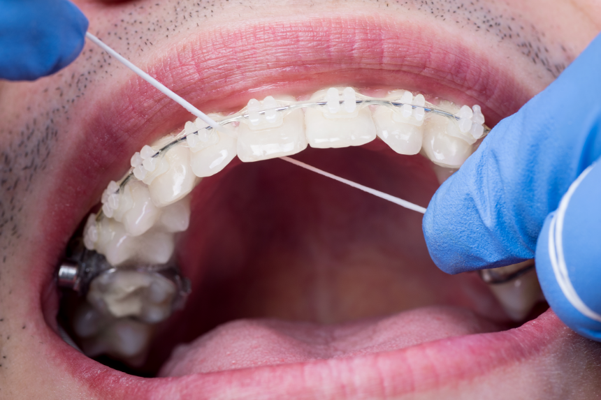 How to use Superfloss with fixed braces. 