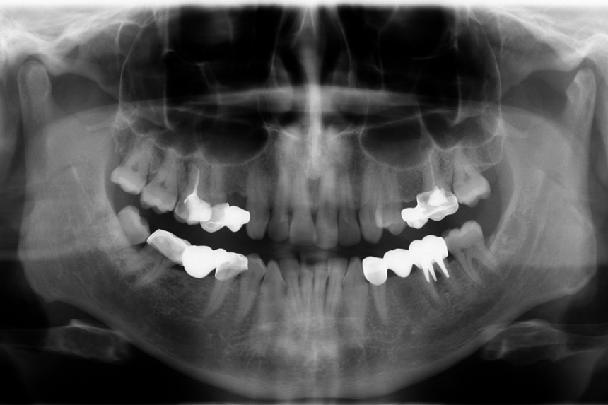 Extraoral X-rays