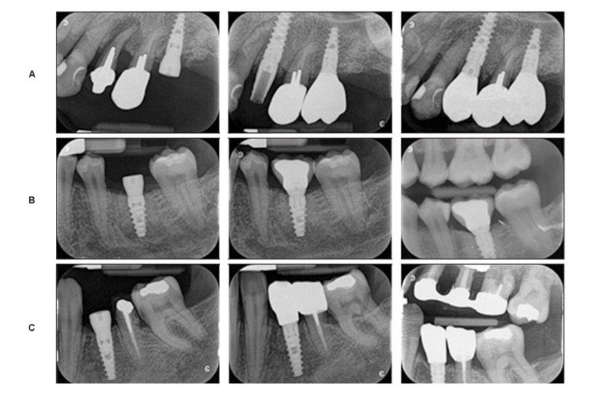 Intraoral X-rays - Alpha Dental Clinic 
