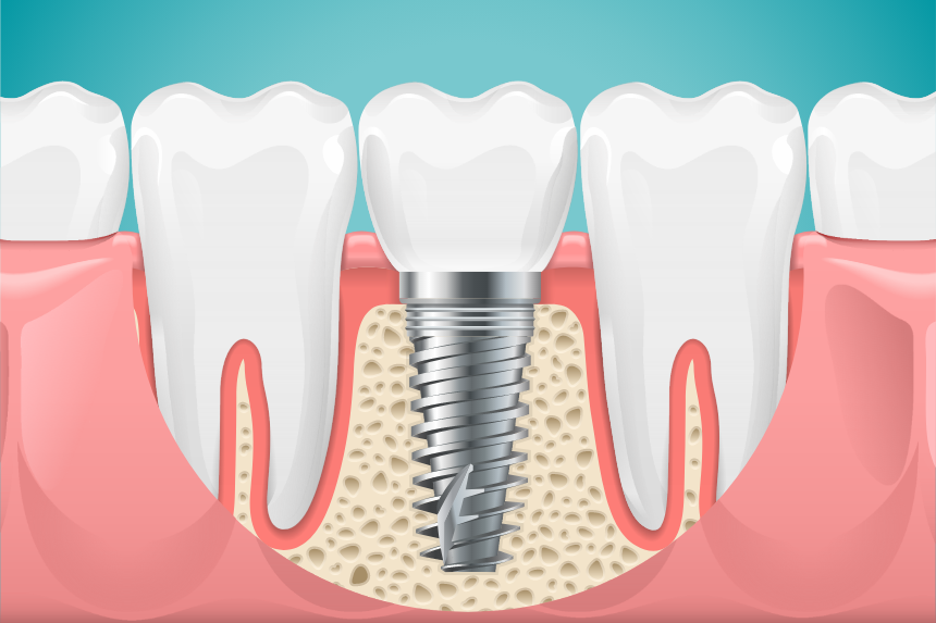 Dental Implants Can They Be Used for Front Teeth?