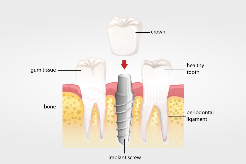 Bone tissue quality