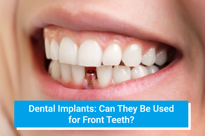 Dental Implants: Can They Be Used for Front Teeth?