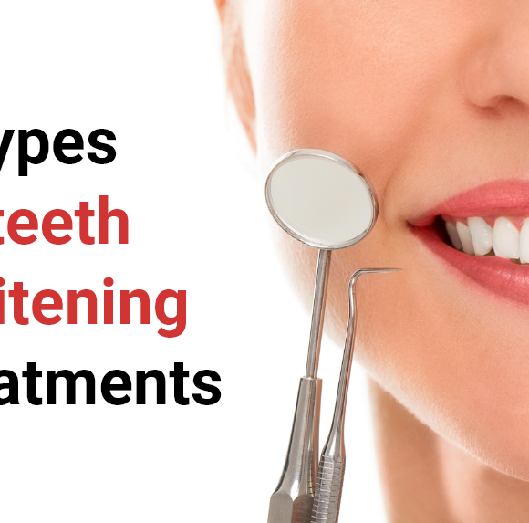 3 types of teeth whitening treatments