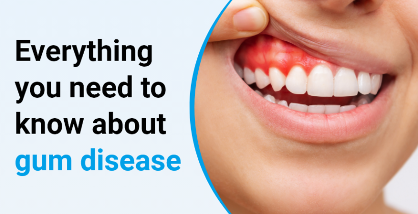 Everything You Need to Know About Gum Disease