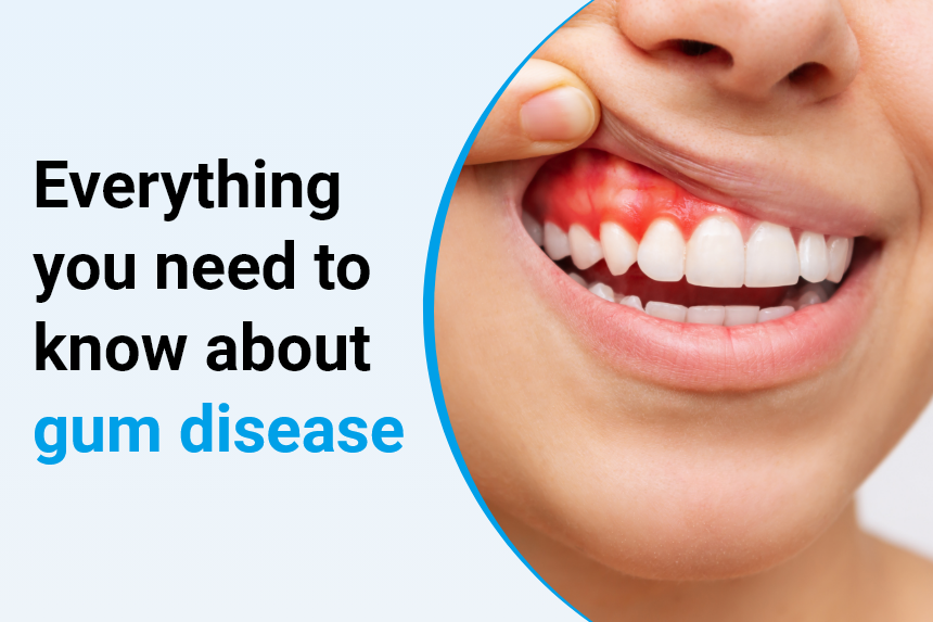 5 Things You Need to Know About Gum Disease - Nottingham Smiles