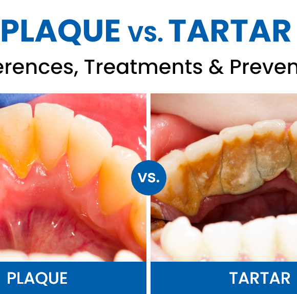 Plaque vs. Tartar: Differences, Treatments & Prevention