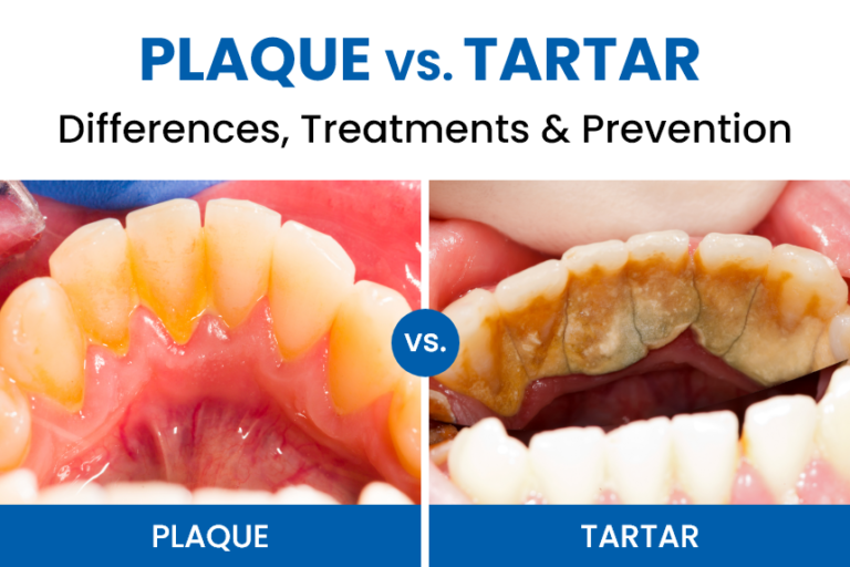 Plaque vs. Tartar Differences, Treatments & Prevention