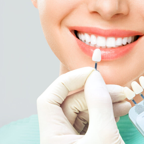 Is Teeth Whitening Right for You? Find out at Alpha Dental Clinic