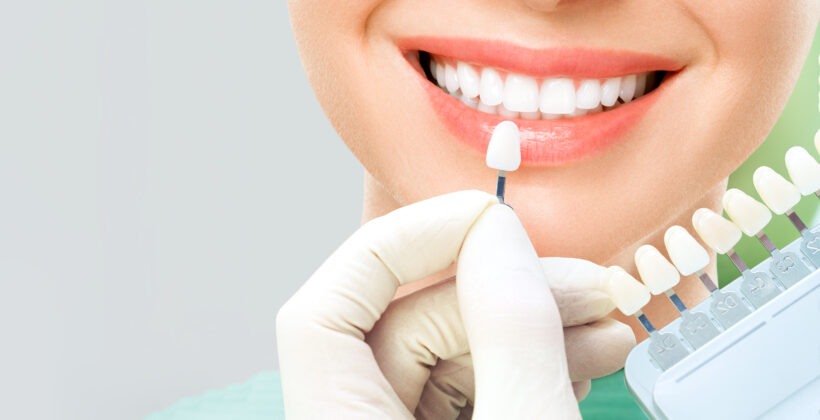 Is Teeth Whitening Right for You? Find out at Alpha Dental Clinic