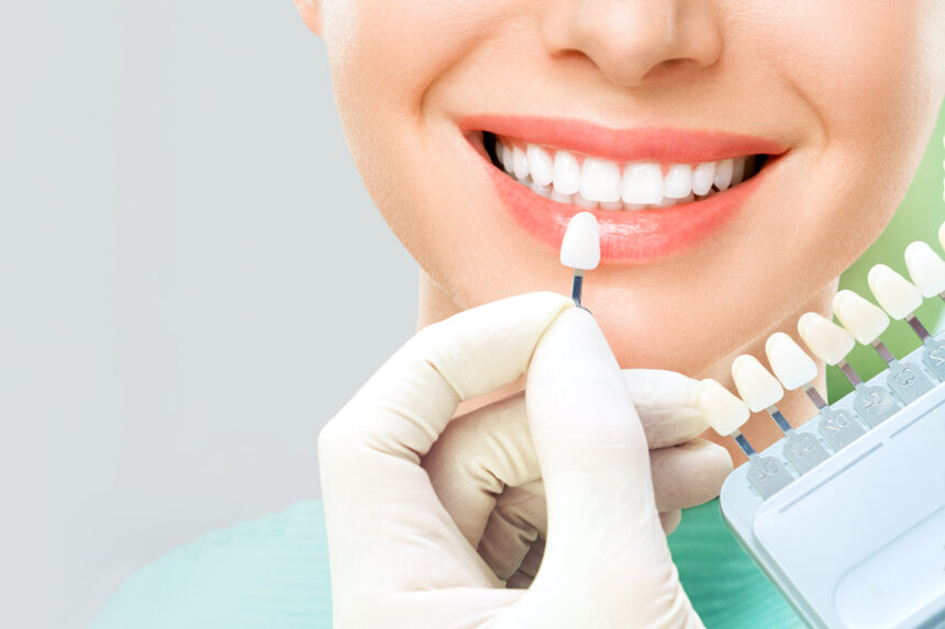 Is Teeth Whitening Right for You? Find out at Alpha Dental Clinic