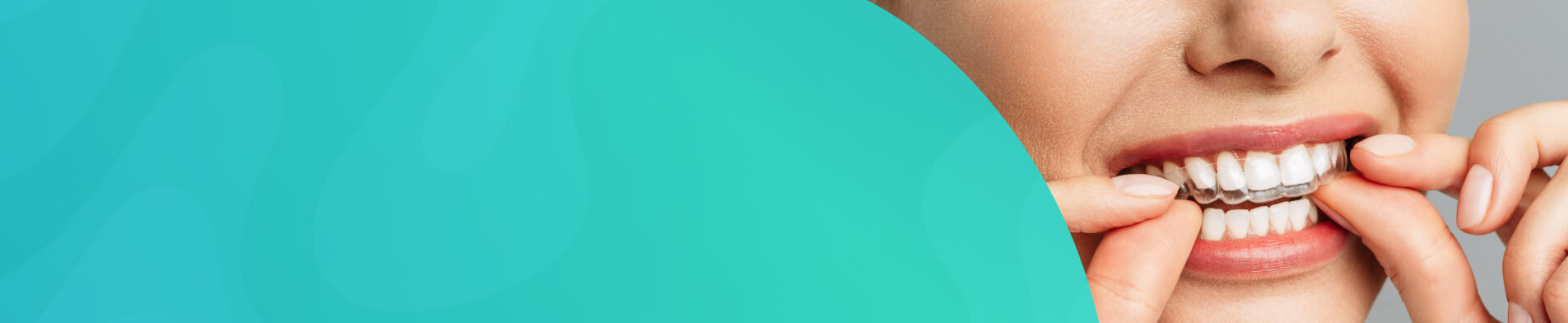 Invisalign Treatment
