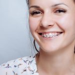 Are Braces Effective for Treating a Gummy Smile?