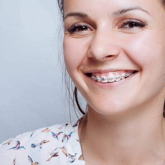 Are Braces Effective for Treating a Gummy Smile?