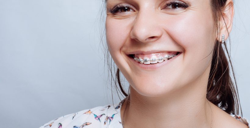 Are Braces Effective for Treating a Gummy Smile?