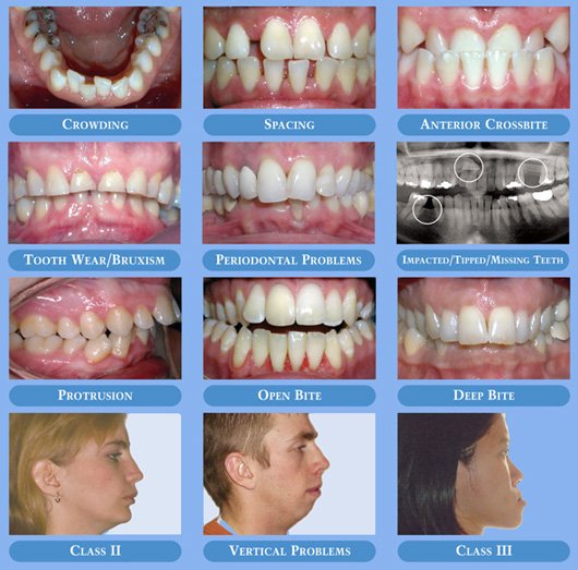 Orthodontic in Brossard, Montreal Orthodontic Treatment